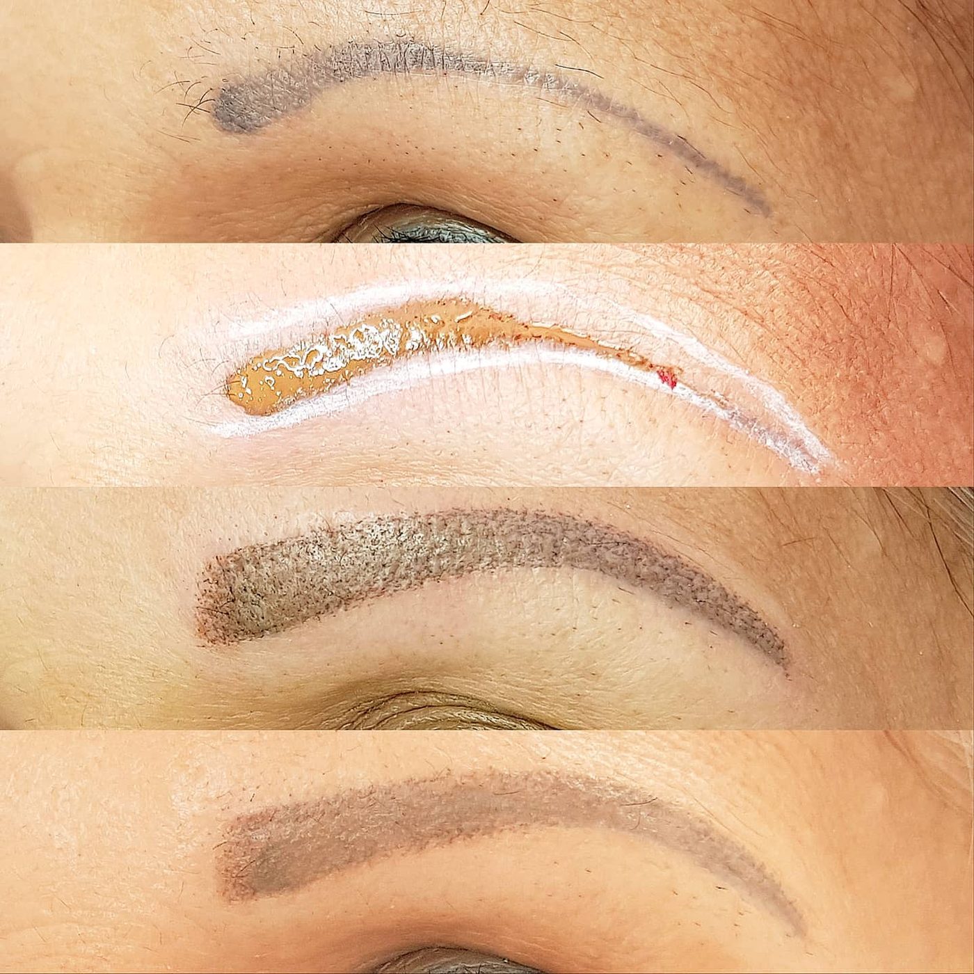 Een herstelbehandeling van foutief geplaatste permanent make-up op een getinte huid, gezet met de Dot-Art behandelmethode. Het resultaat voor - direct na - genezen na slechts 1 behandeling